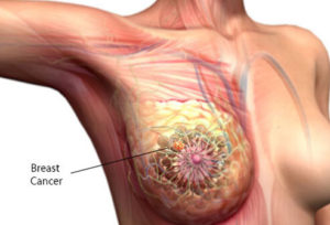 10-things-about-breast-cancer-what-is-breast-cancer